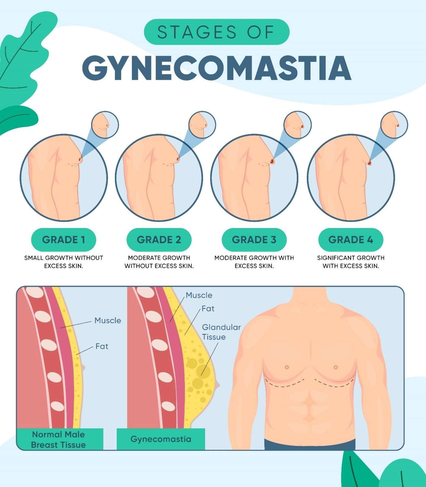 Does Gyno Go Away