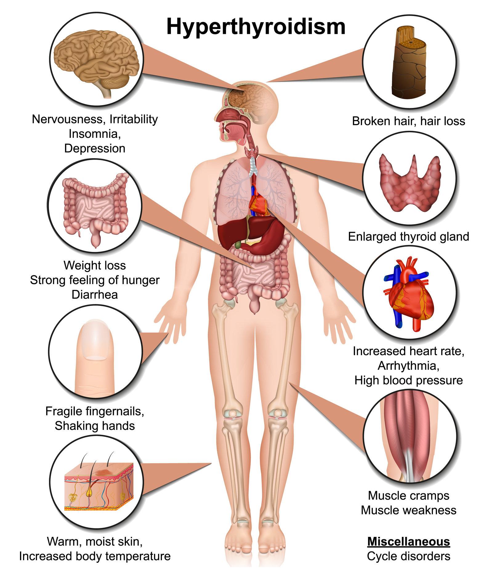 Does Hyperthyroidism Cause Weight Gain