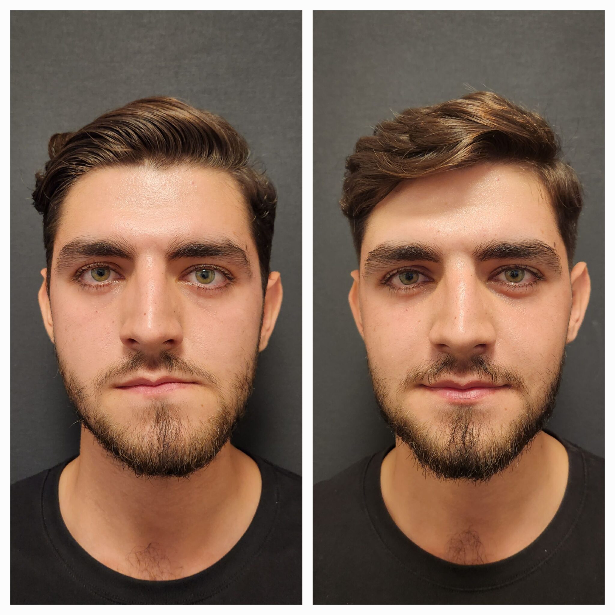 Does Jaw Surgery Change Your Face