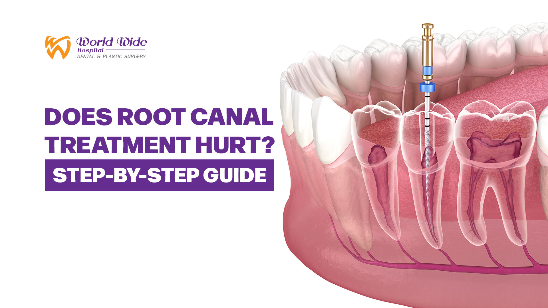 Does Root Canal Hurt
