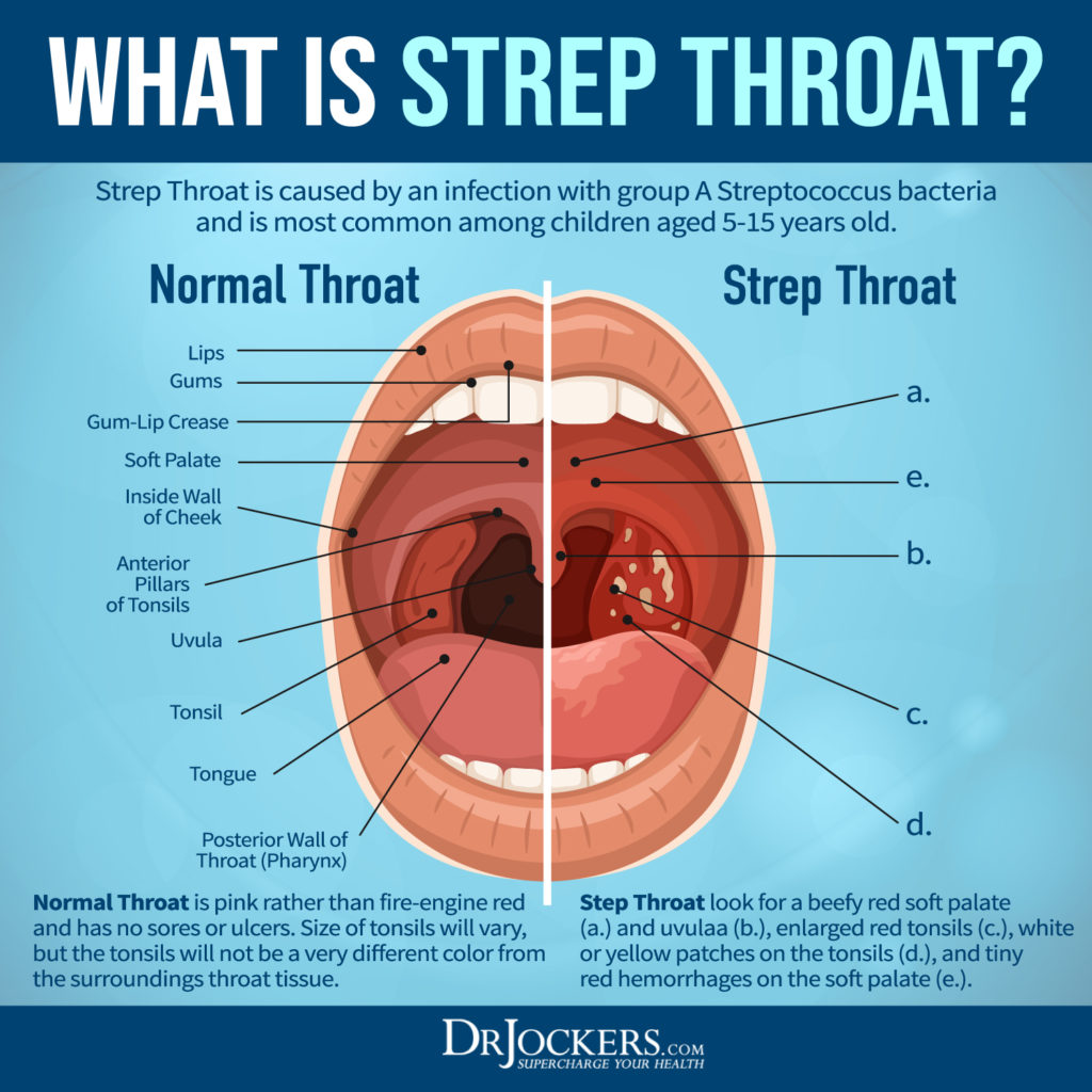 Does Strep Cause A Cough