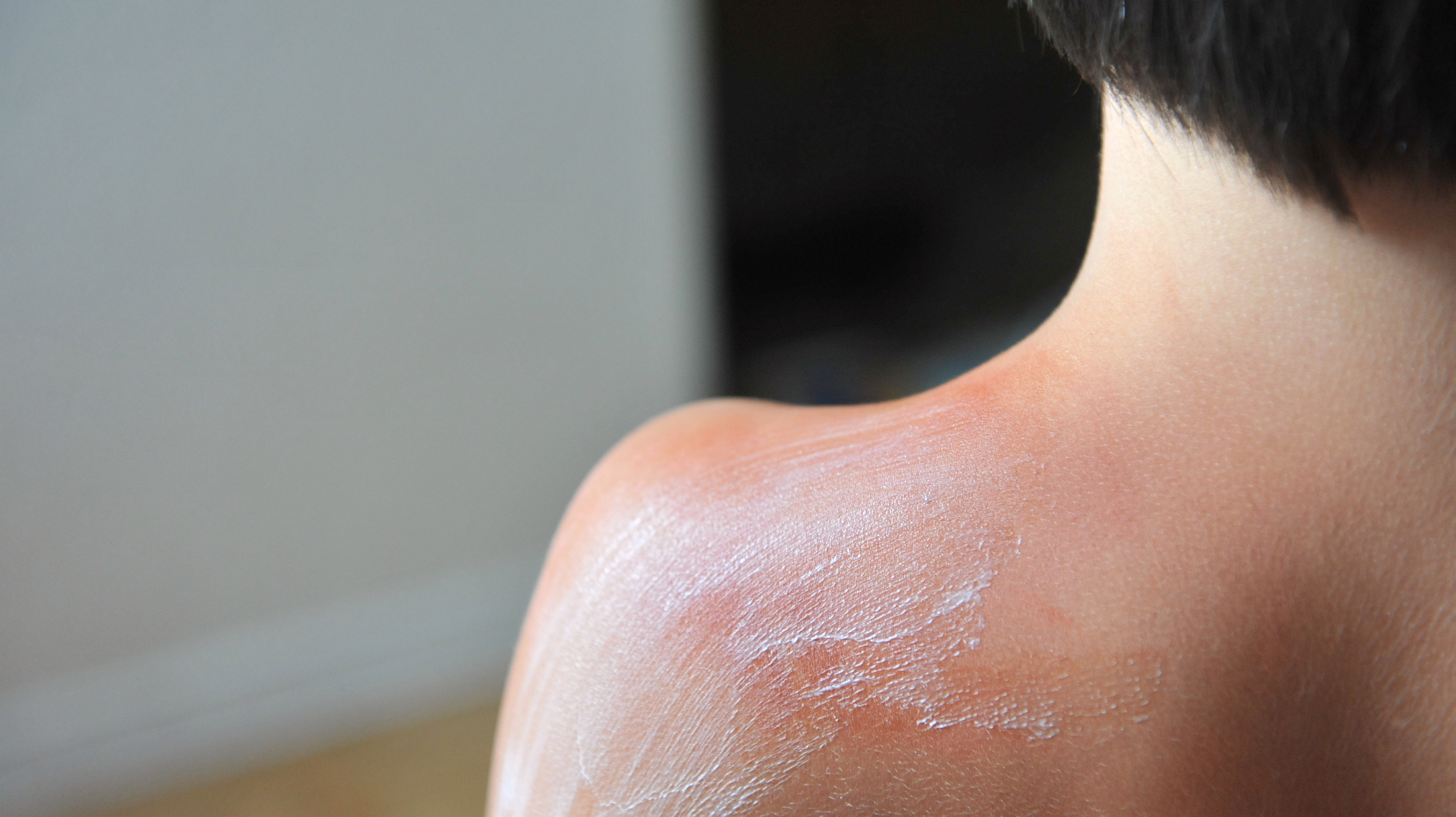 Does Sunburn Turn Tan