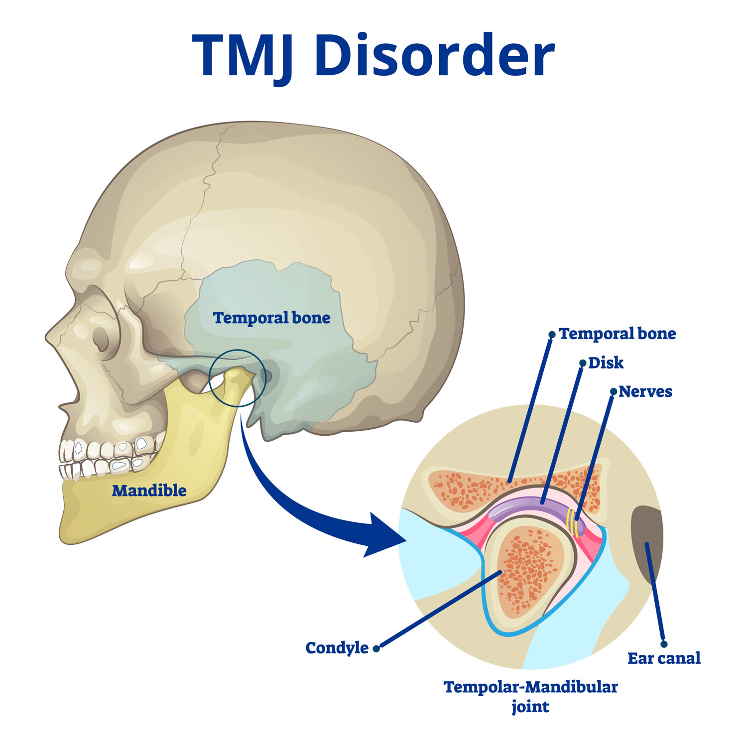 Does Tmj Causes Headache