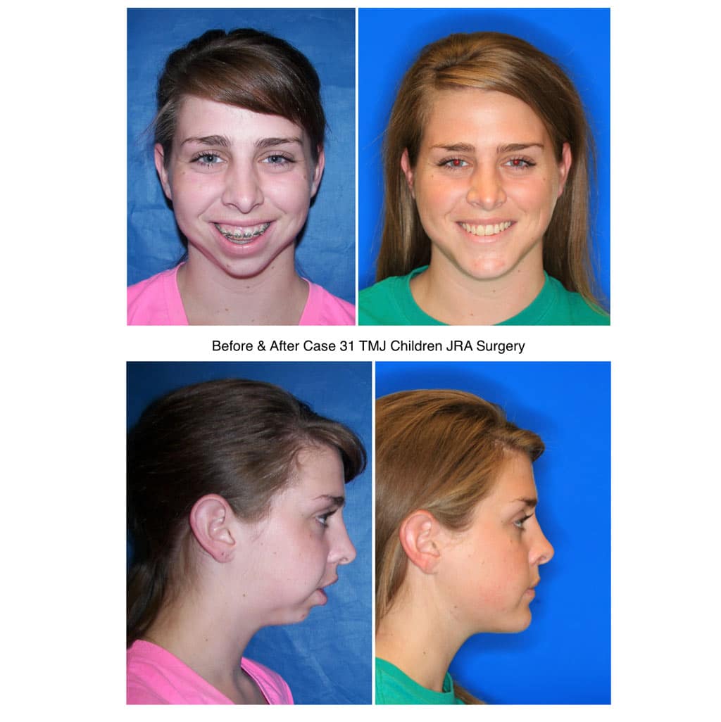 Does Tmj Surgery Change Your Face