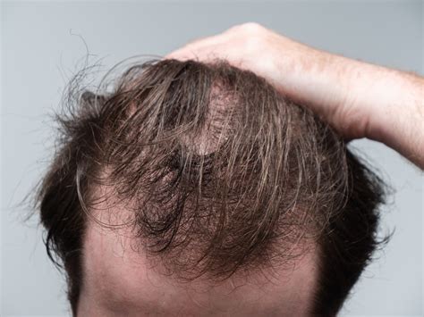 Does Zepbound Cause Hair Loss