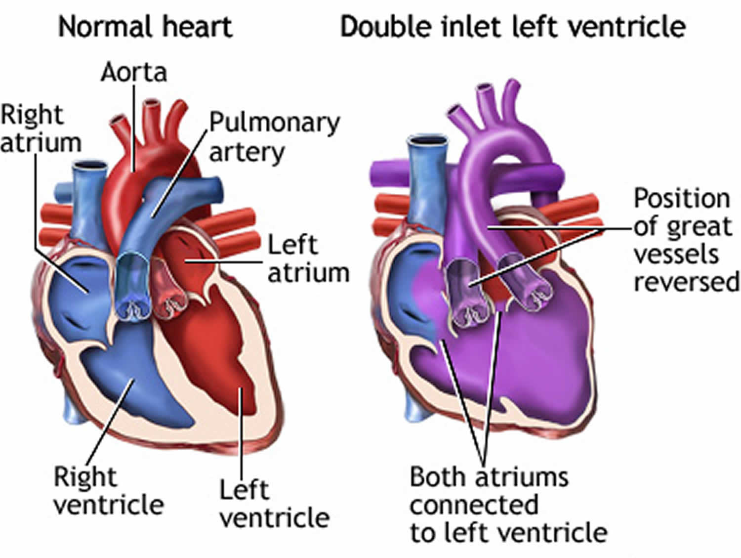 Double Inlet Left Ventricle