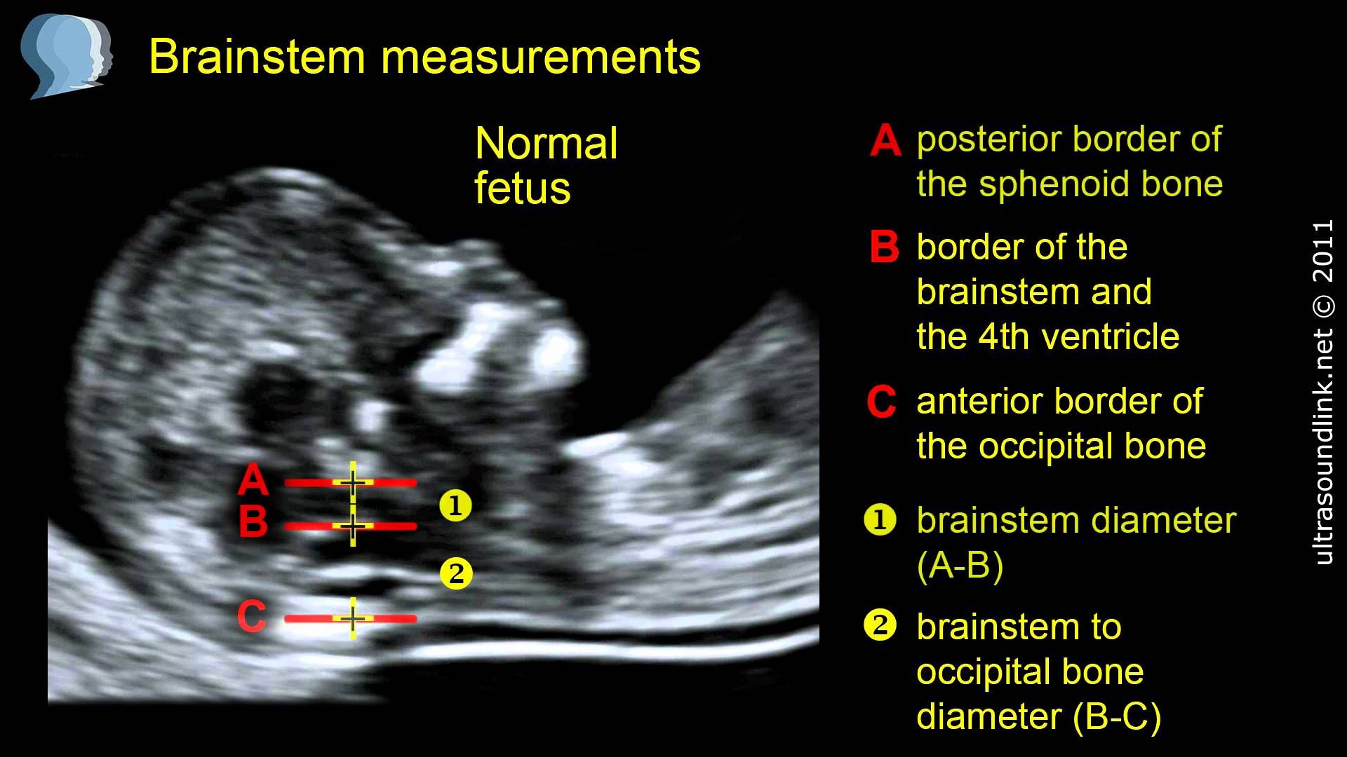 Downs Syndrome On Ultrasound