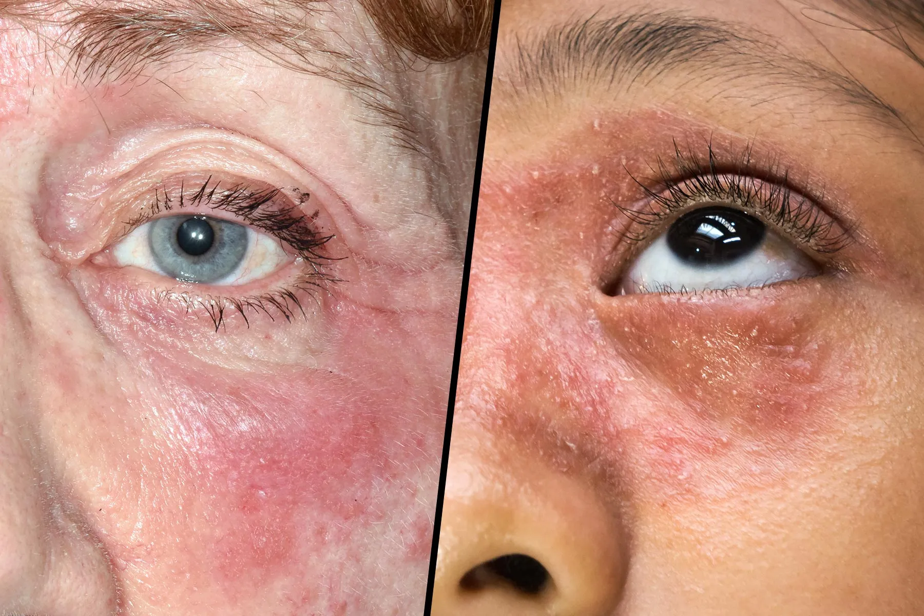 Dry Patches On Penus