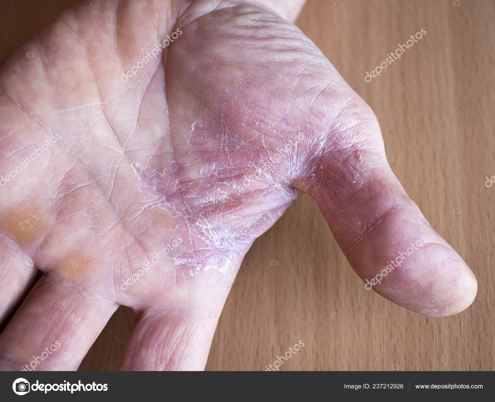 Dry Skin On Hands