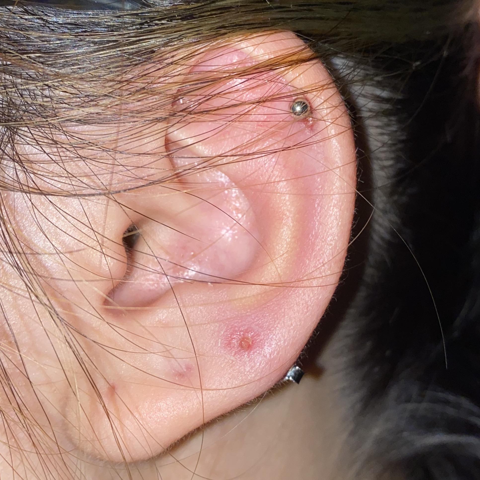 Ear Infection Earring Hole
