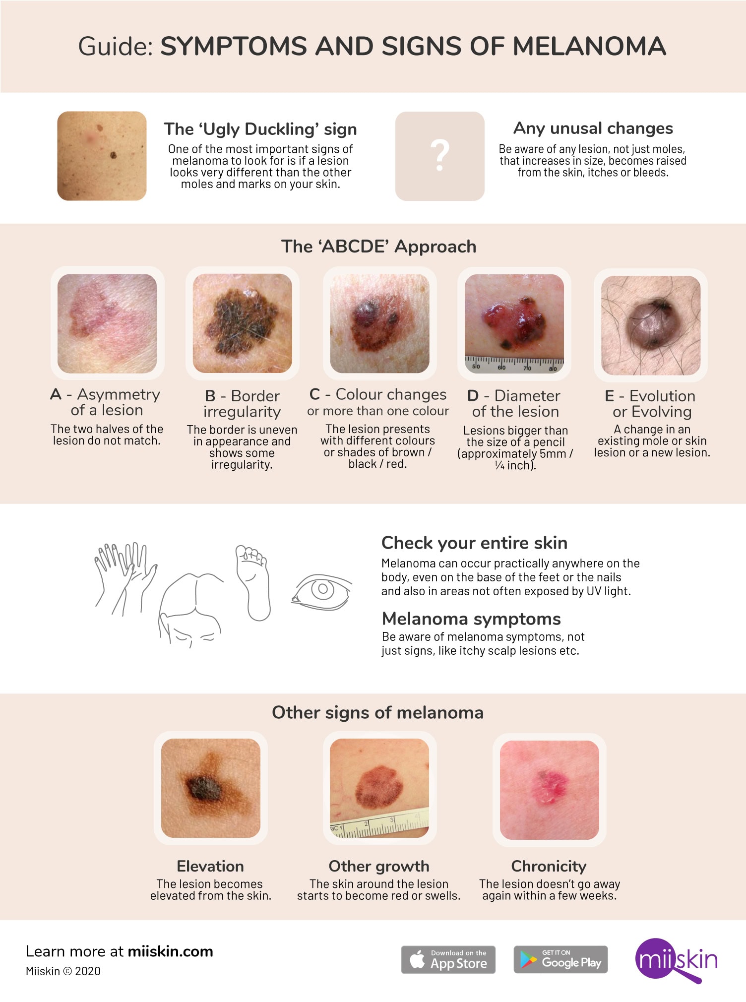 Early Melanoma Symptoms