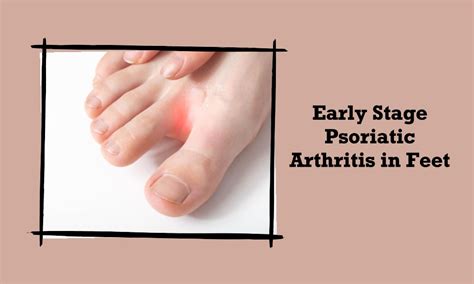 Early Stage Arthritis In Feet