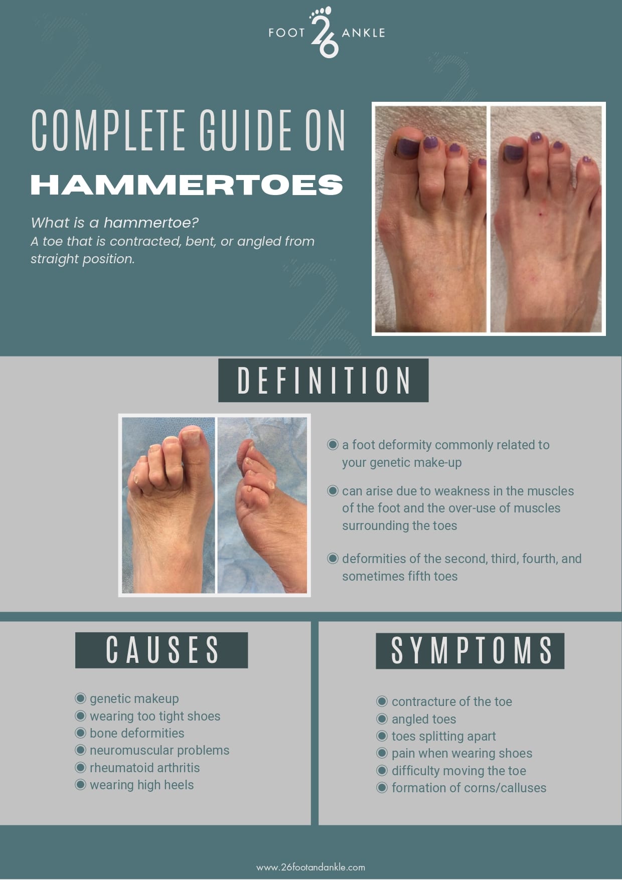 Early Stage Mild Hammer Toes