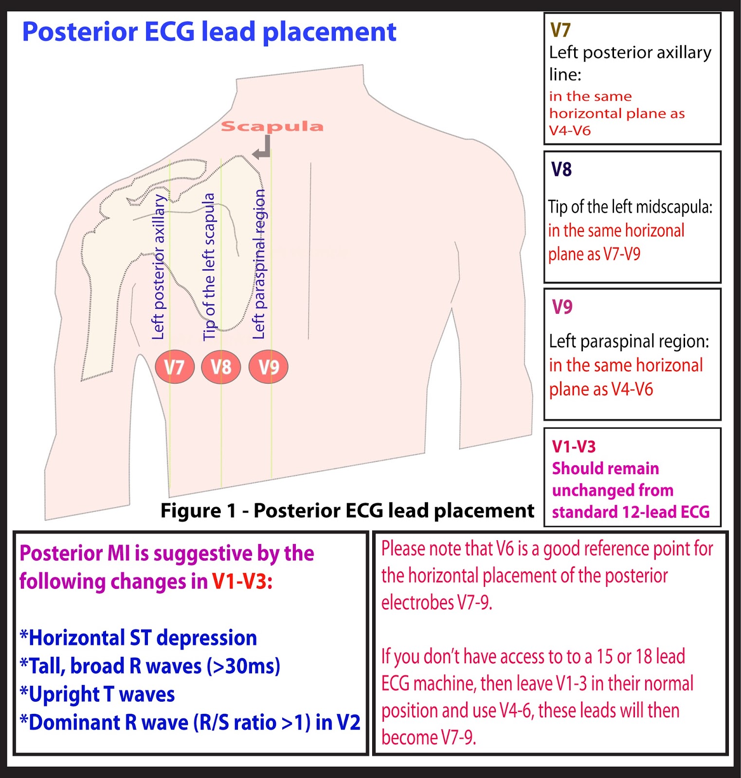 Ecg Lead Placement