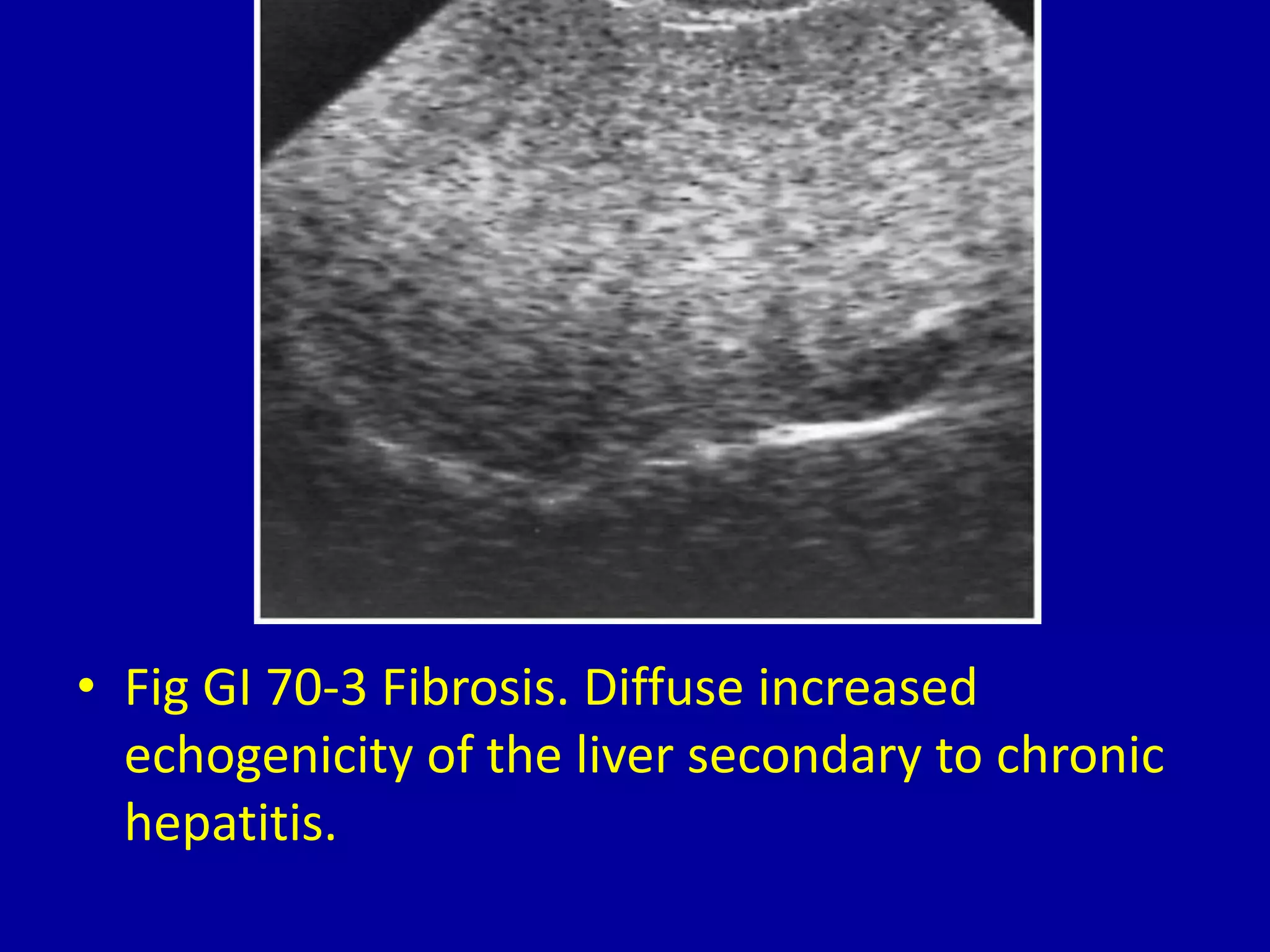 Echogenicity Of The Liver