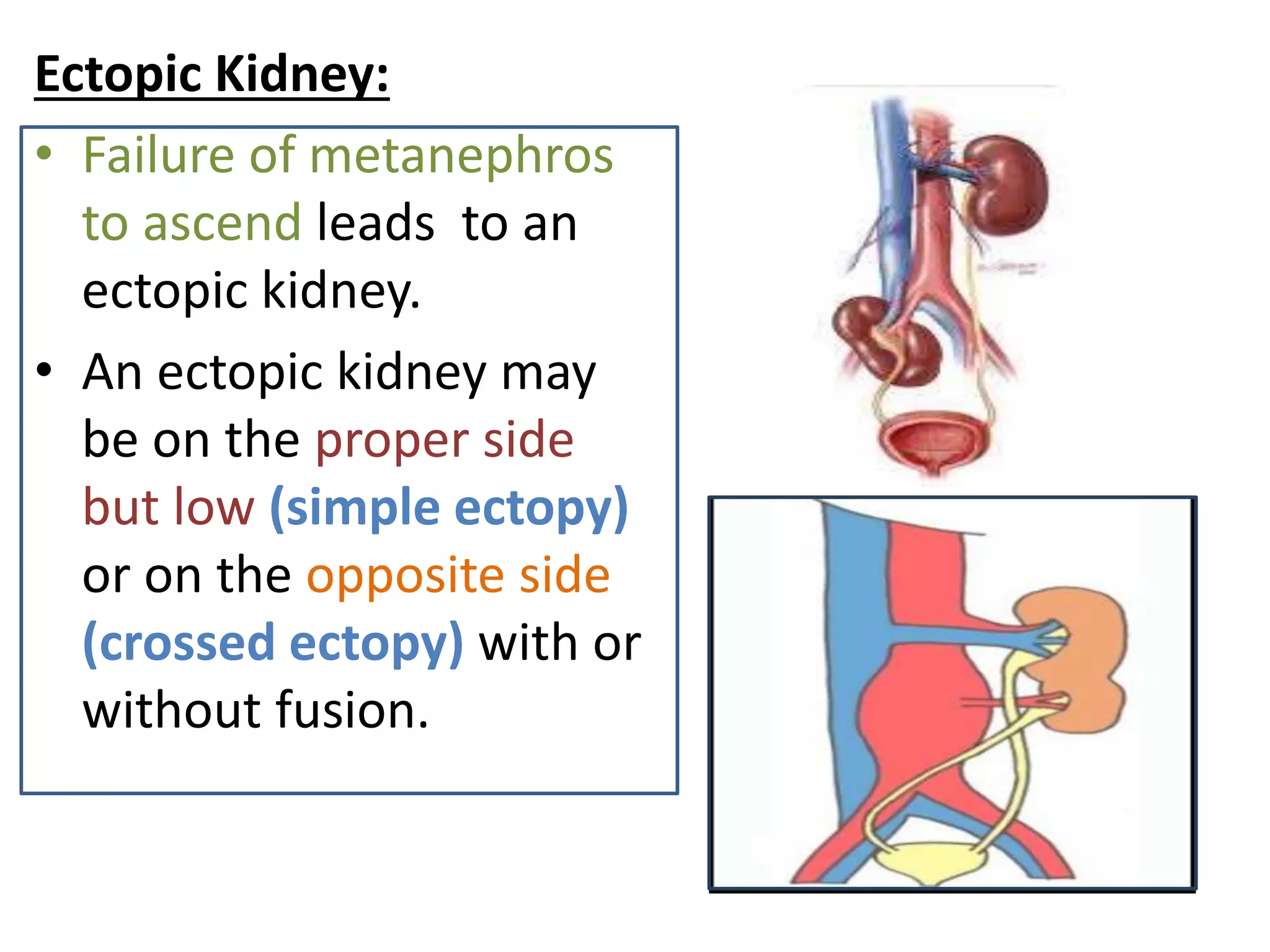 Ectopic Kidney Disease