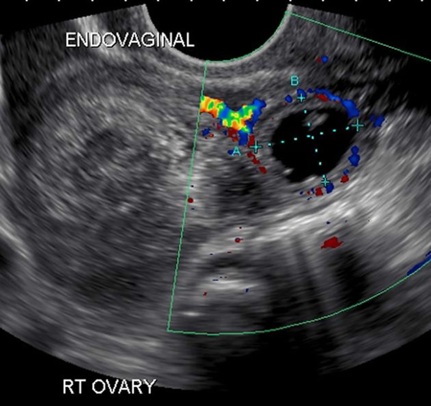 Ectopic Pregnancy By Ultrasound