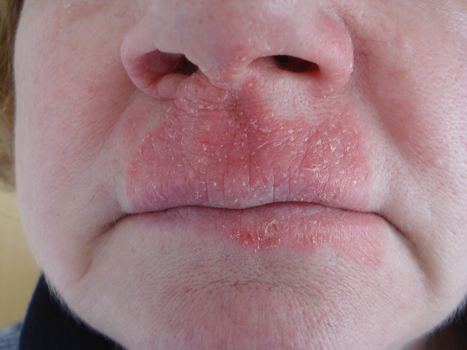 Eczema Around Mouth
