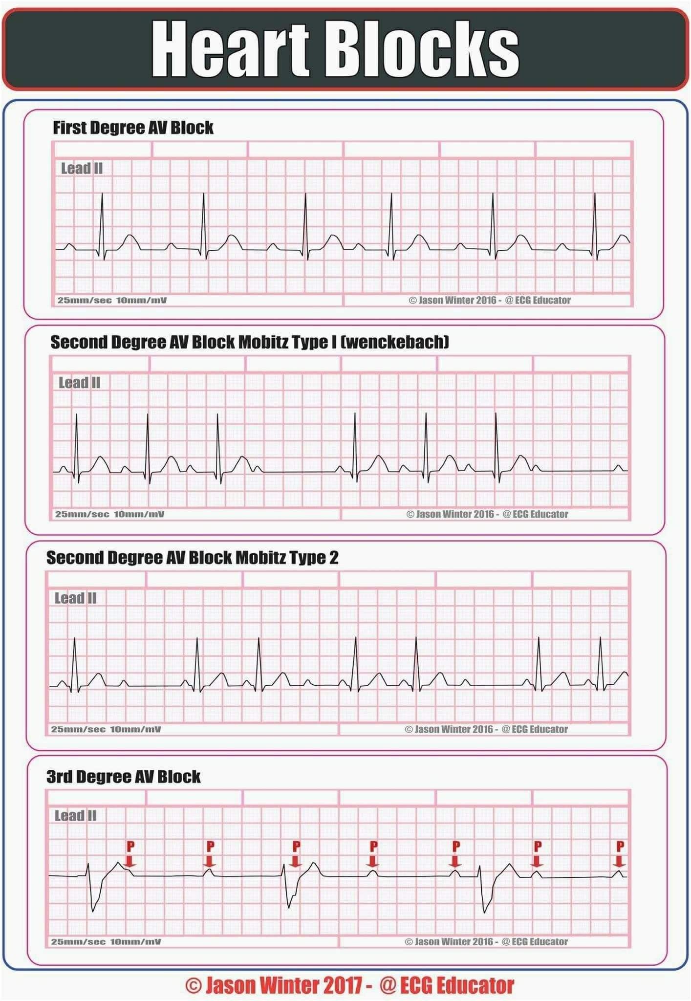 Ekg Practice Strips