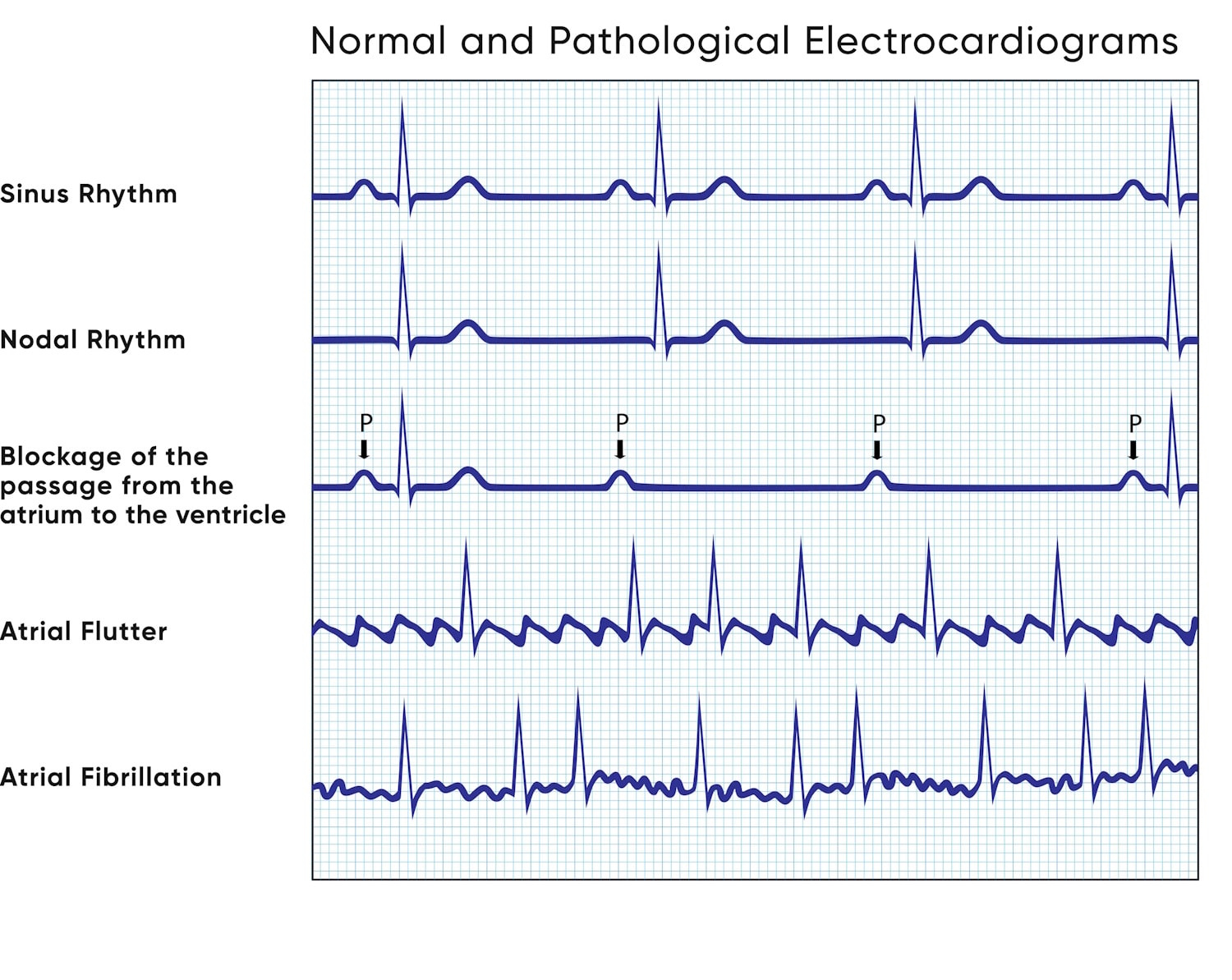 Electrocardiography Of Arrhythmias