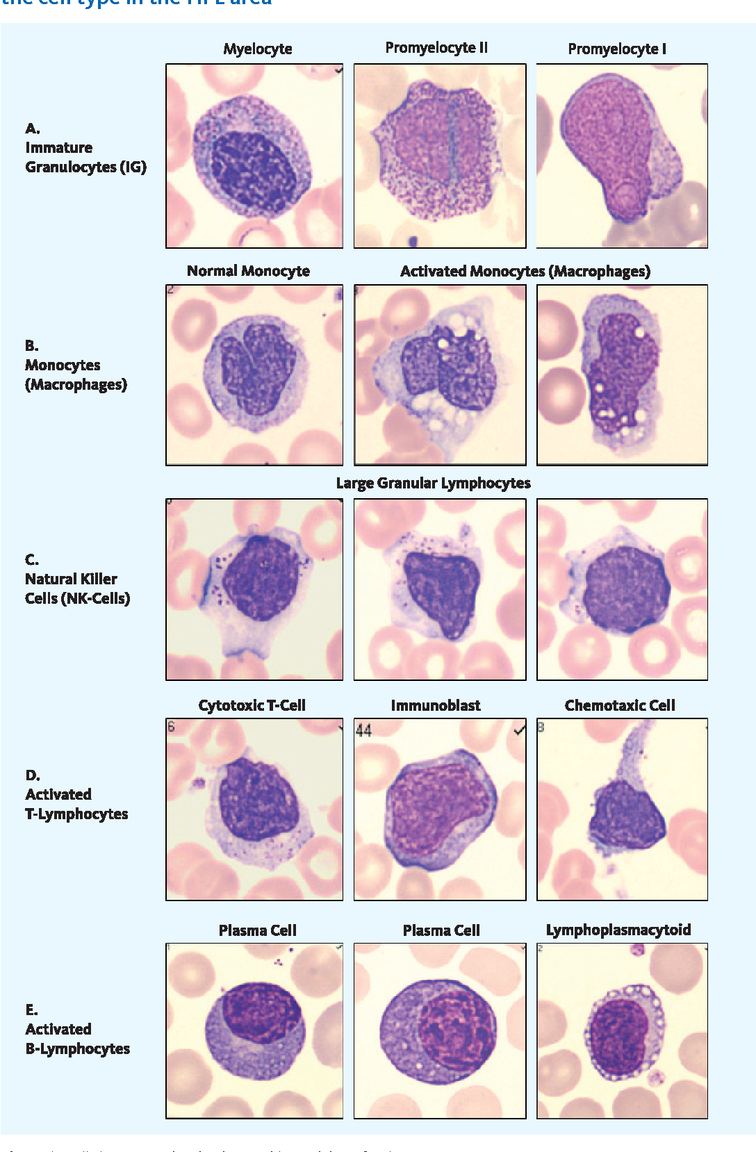 Elevated Immature Granulocytes
