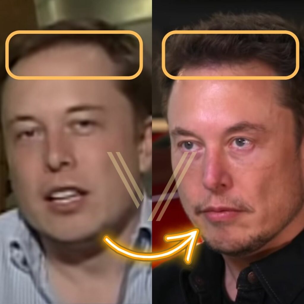 Elon Musk Before Face Surgery