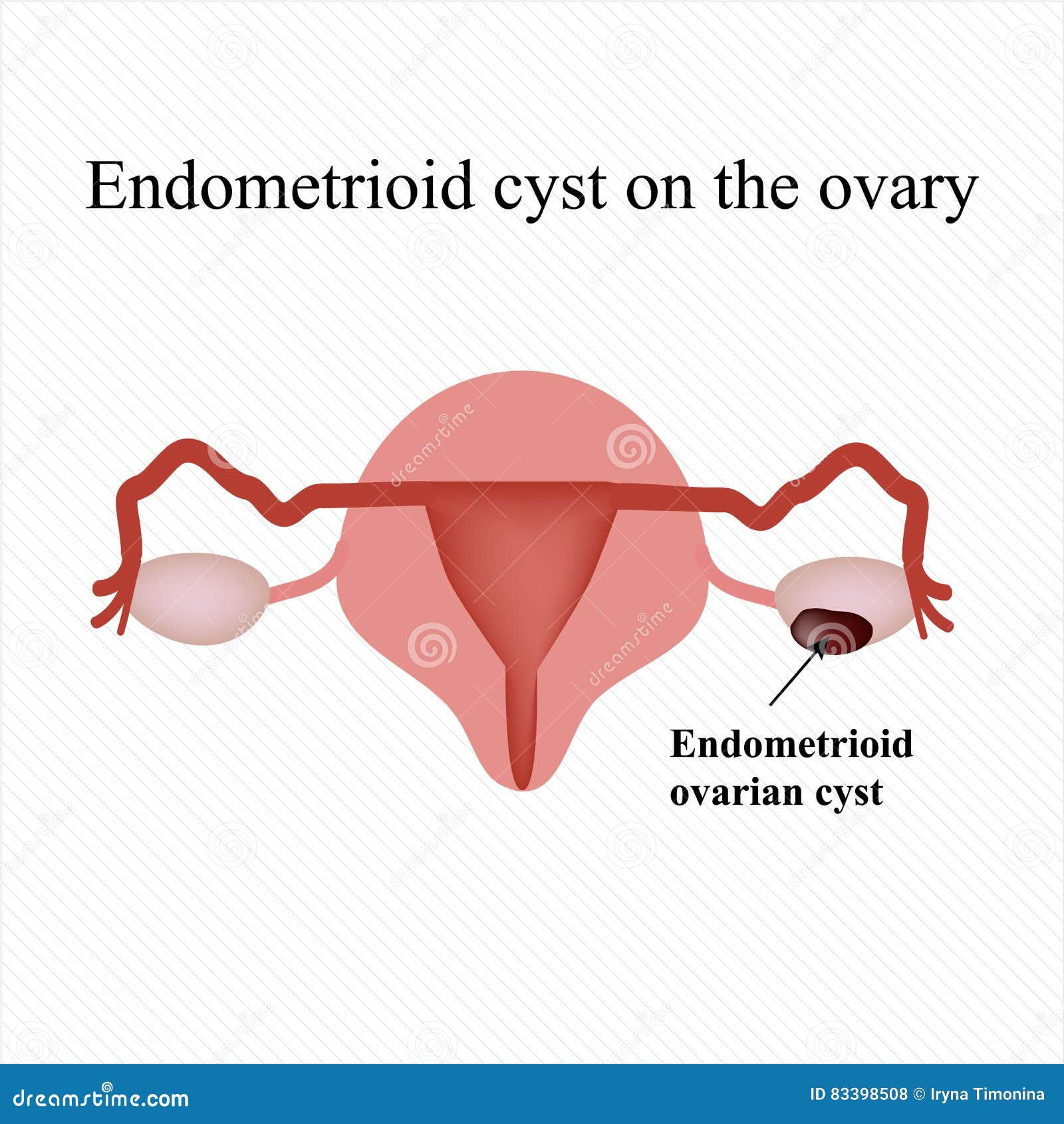 Endo Cyst Ovary
