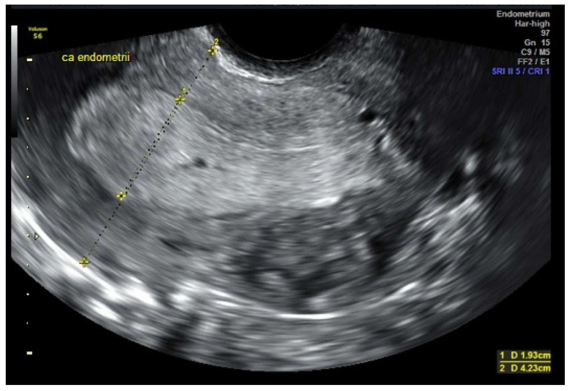 Endometrial Cancer Ultrasound