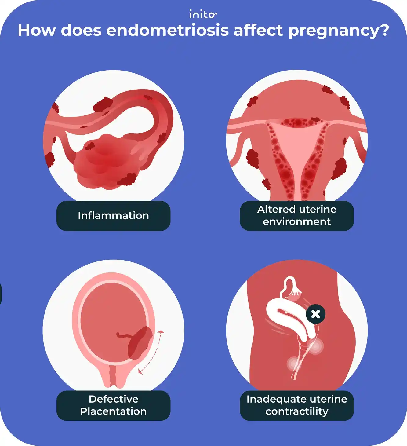 Endometriosis Does It Affect Pregnancy