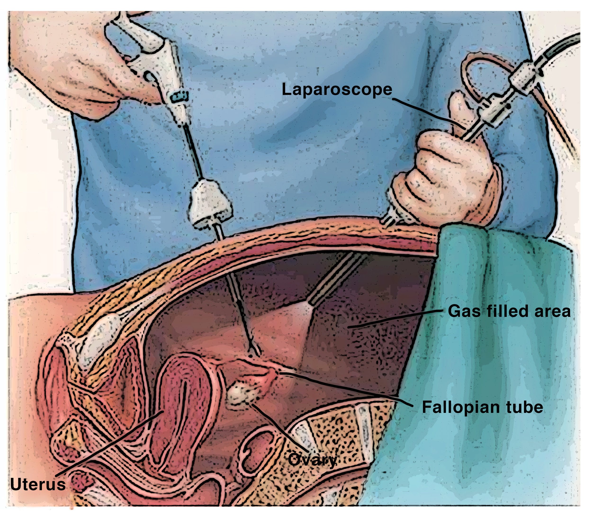 Endometriosis Laparoscopic Surgery