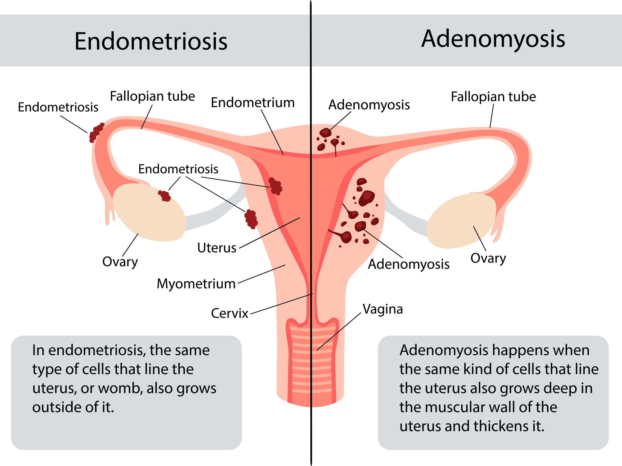 Endometritis Vs Endometriosis