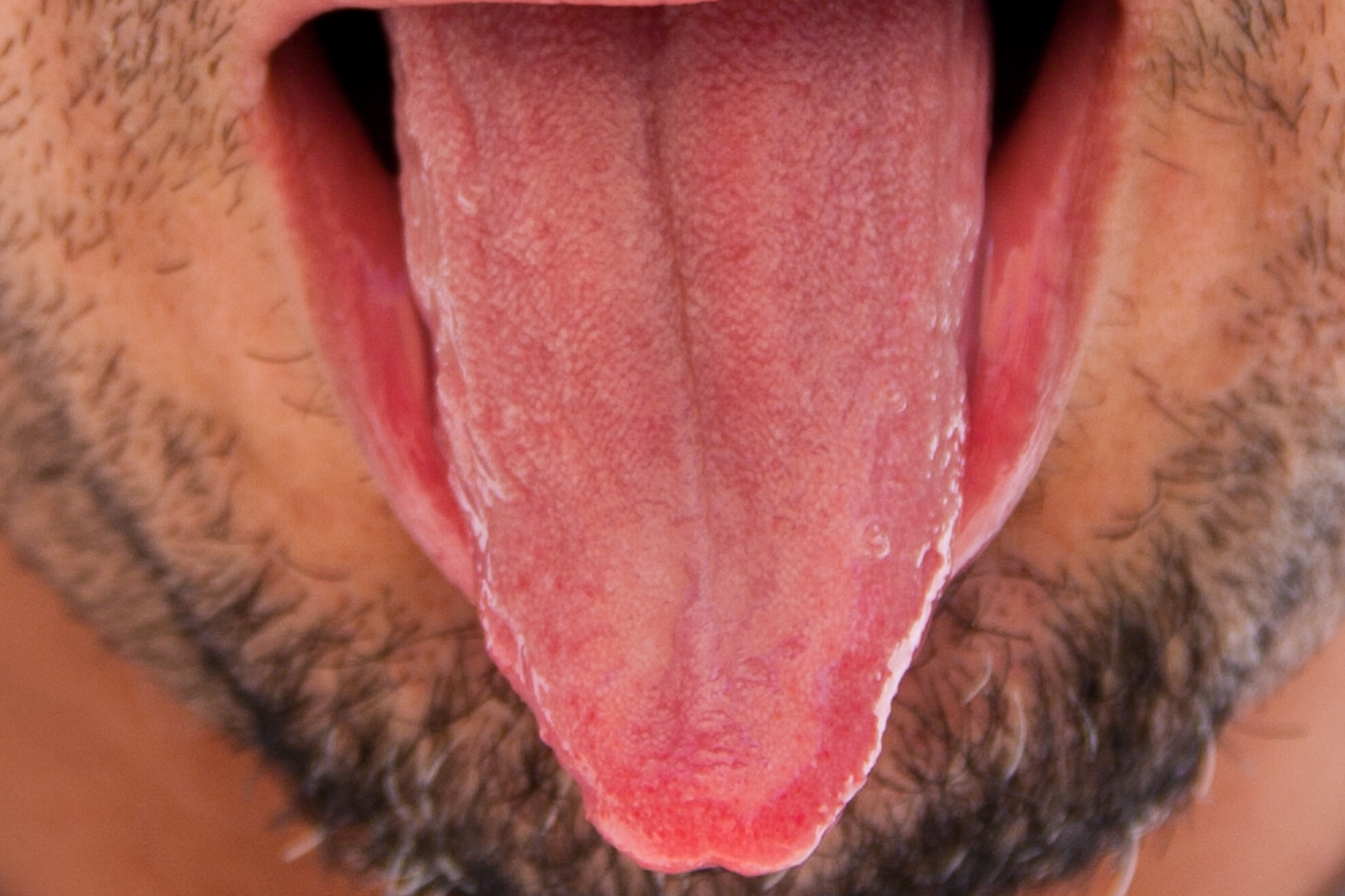 Enlarged Taste Buds Tongue
