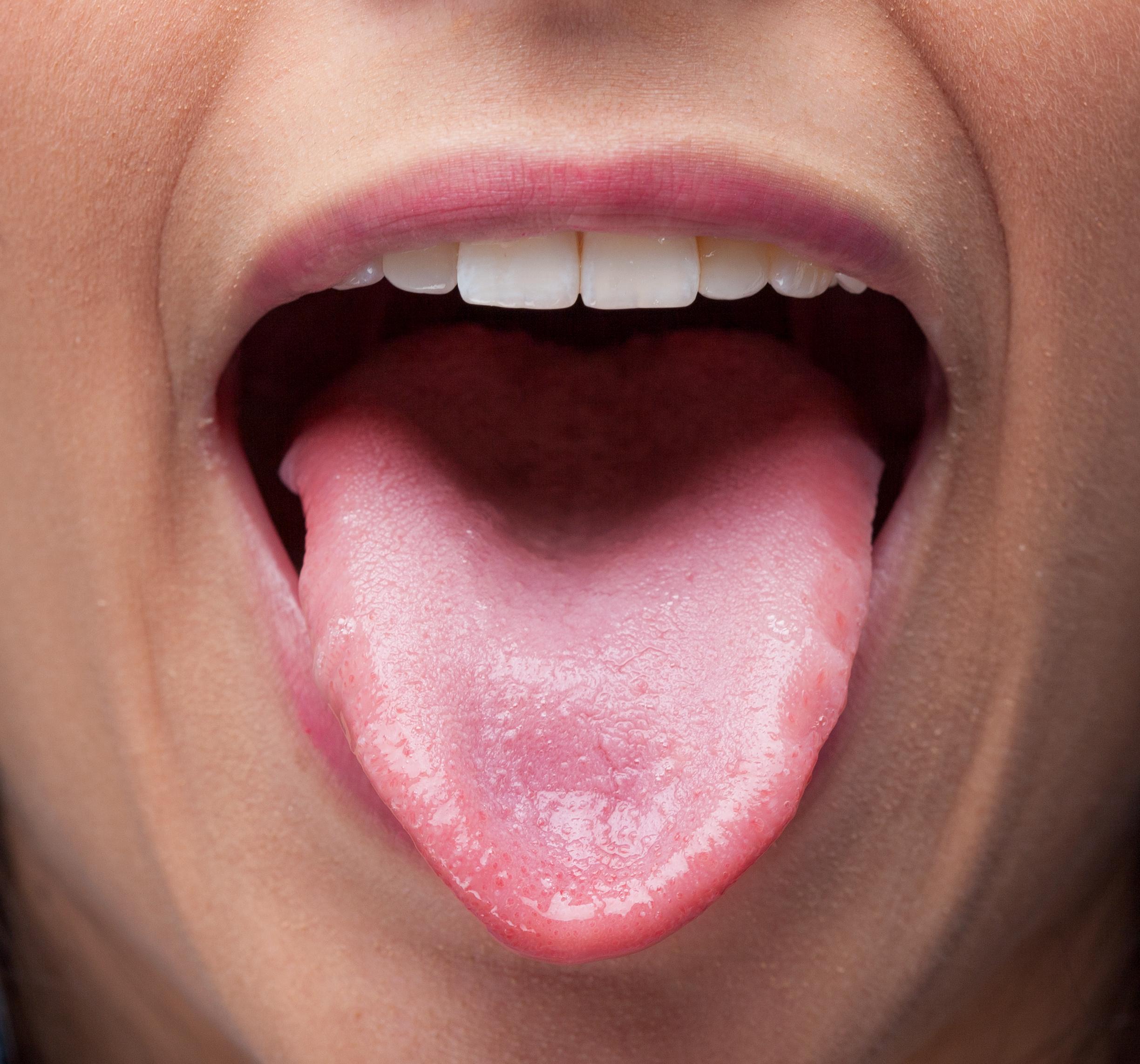 Enlarged Taste Buds