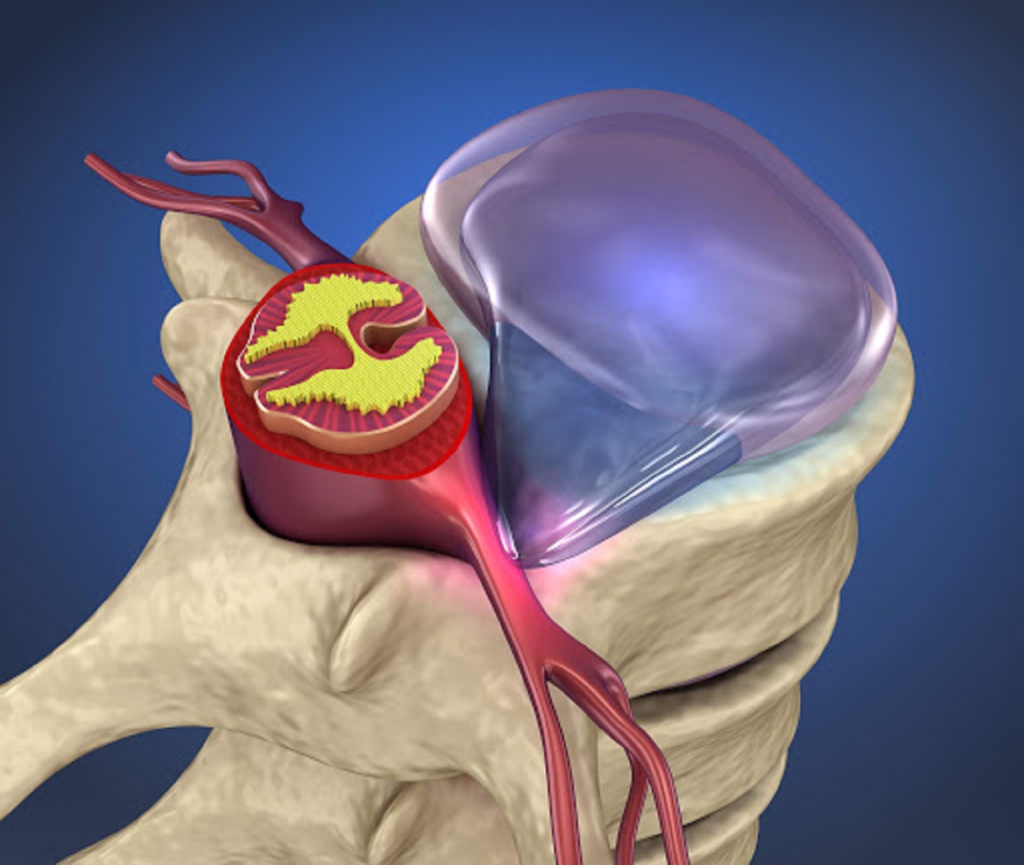 Epidural Injection For Disc Prolapse