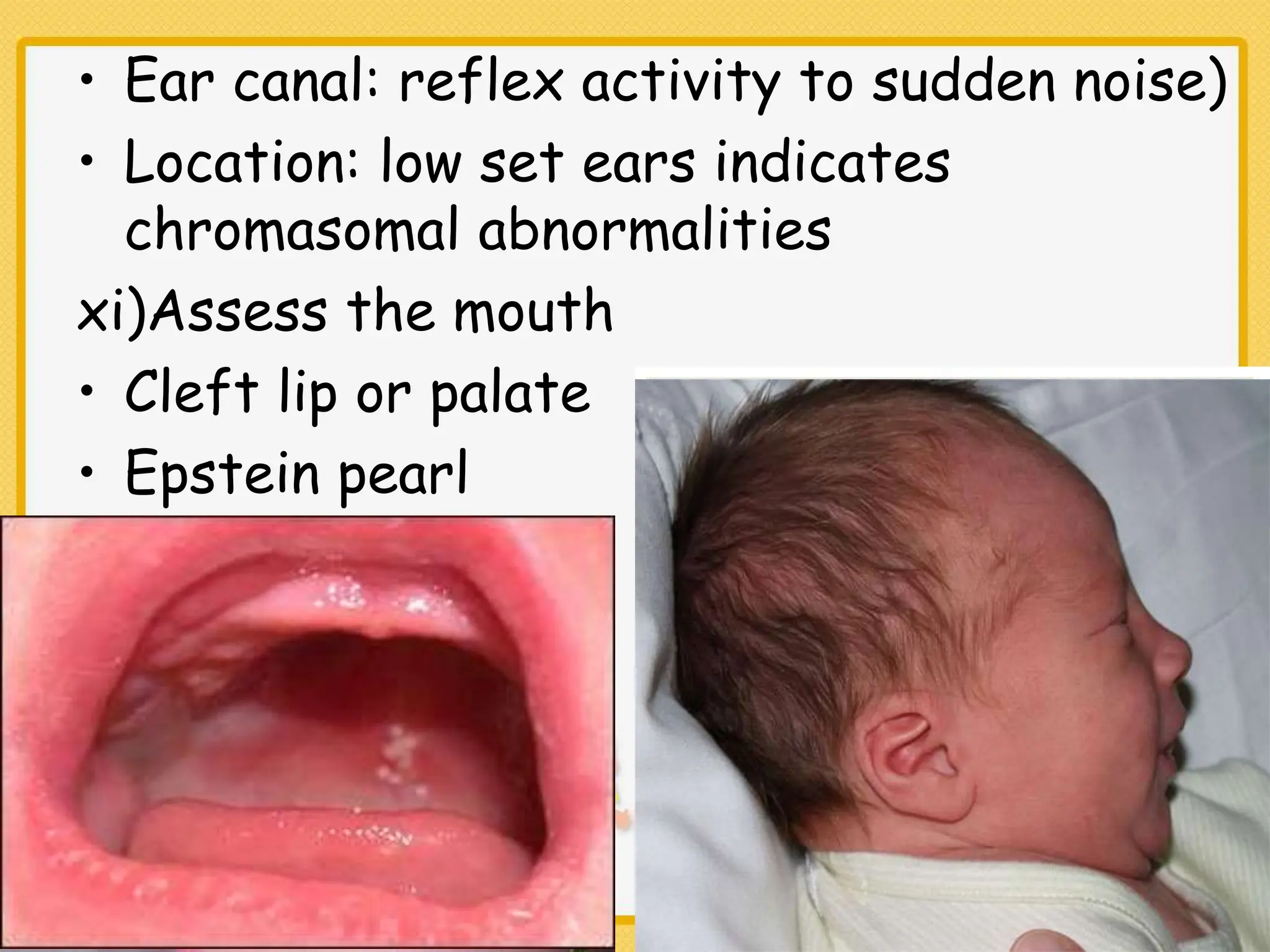 Epstein Pearls Newborn