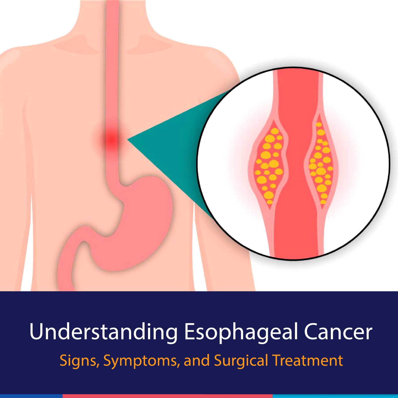 Esophagus Cancer Symptoms