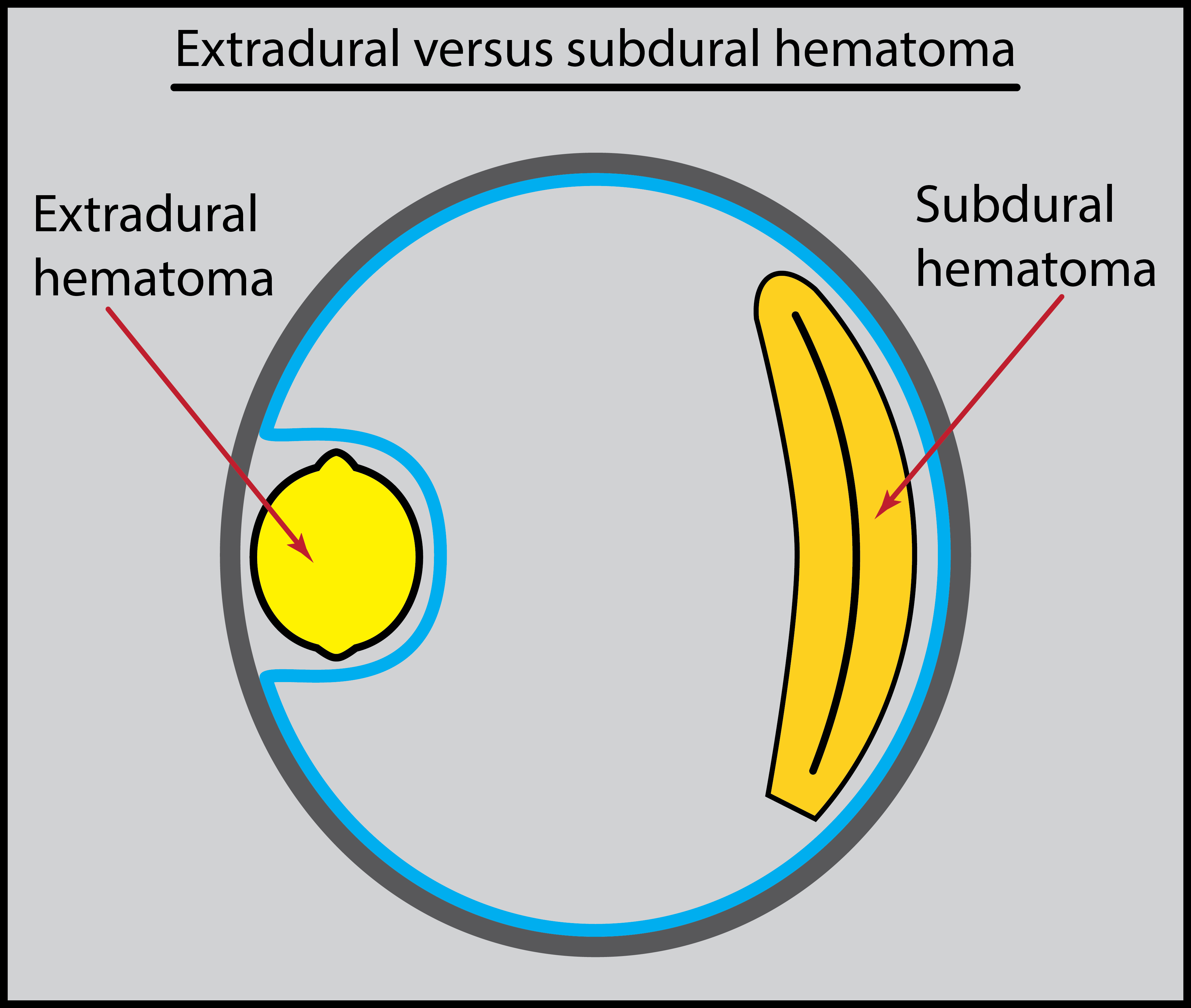 Extradural Vs Subdural Haemorrhage