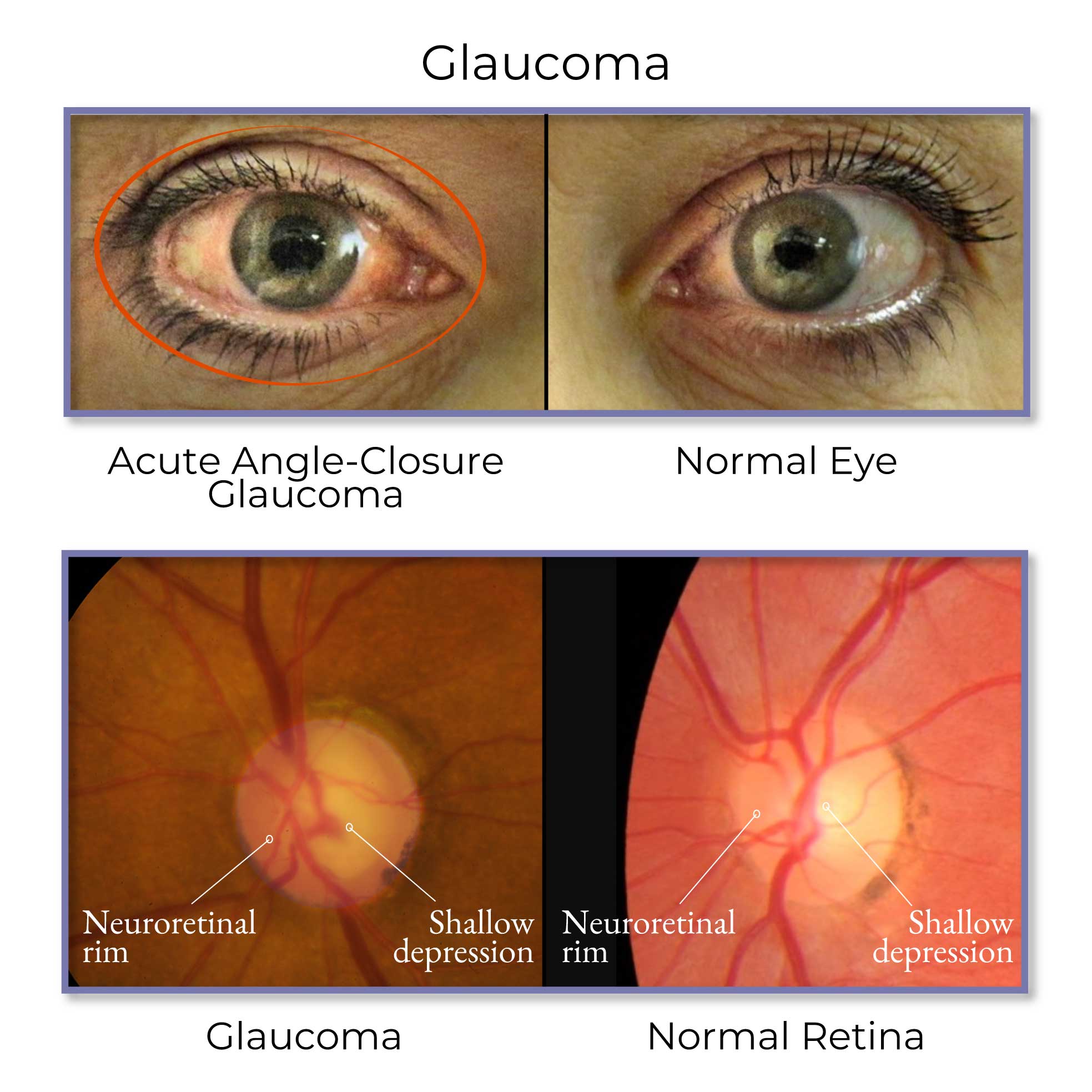 Eye Examination Glaucoma