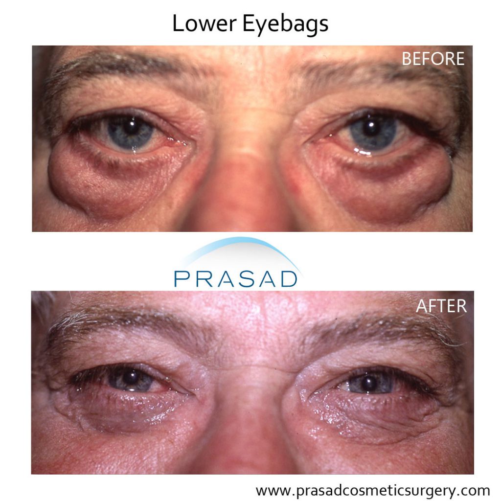 Eye Surgery For Bags