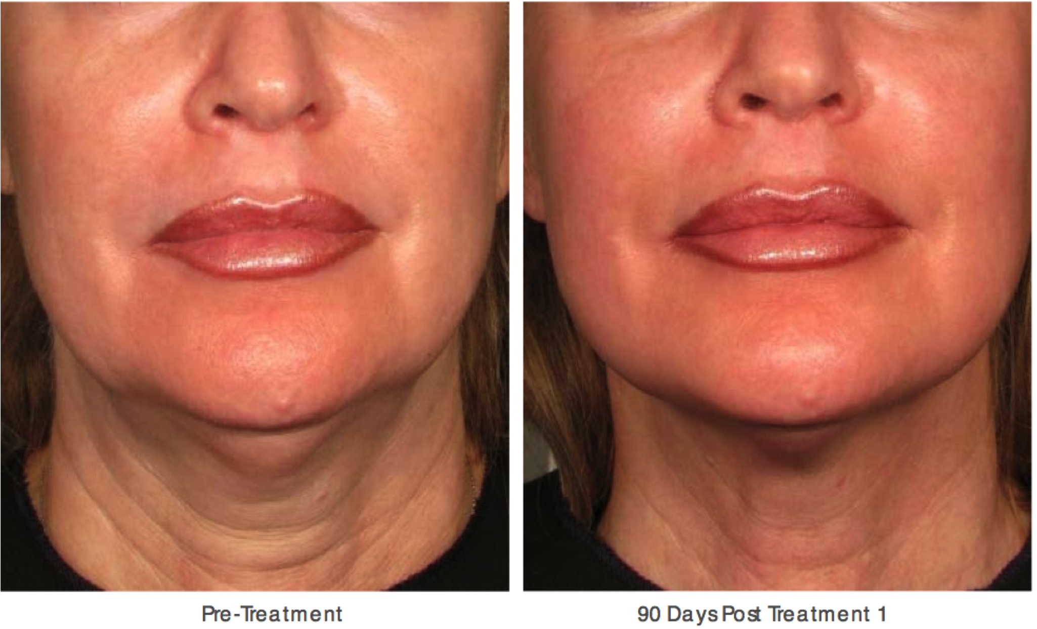 Face And Neck Lift Without Surgery