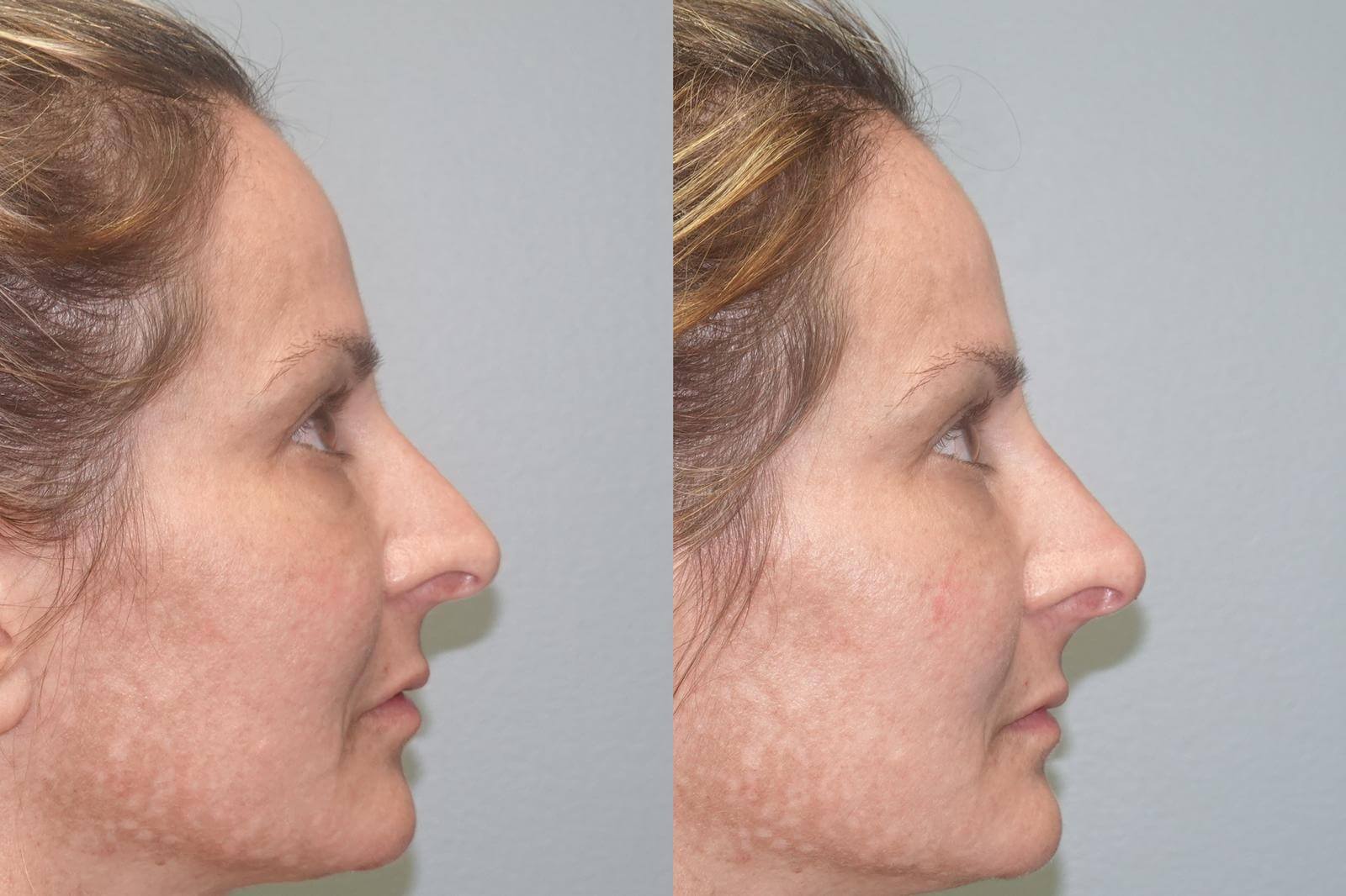 Face Asymmetry Surgery