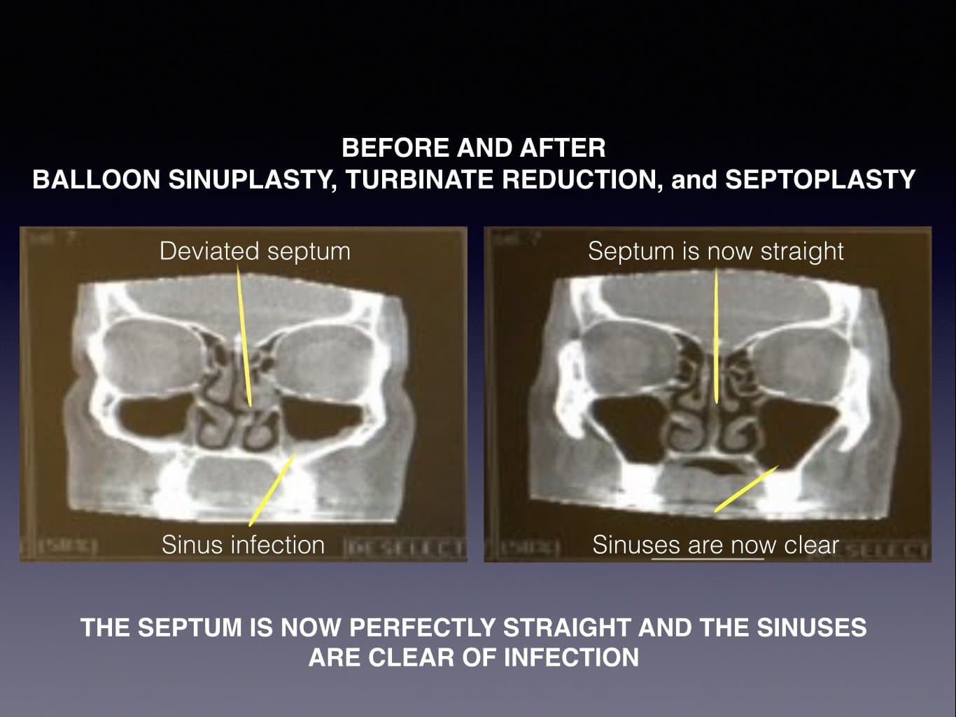 Face Before And After Sinus Surgery