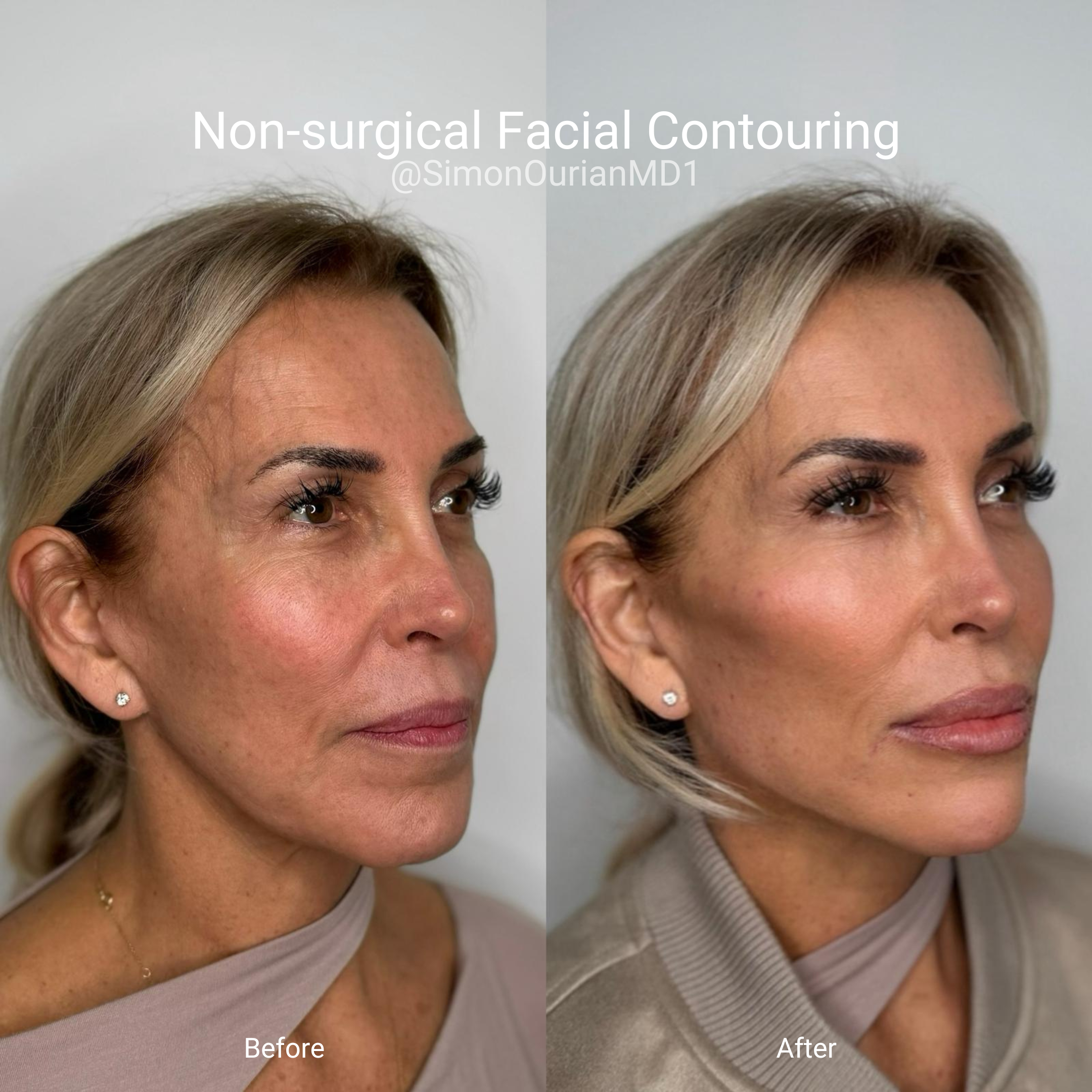 Face Contour Surgery Before And After