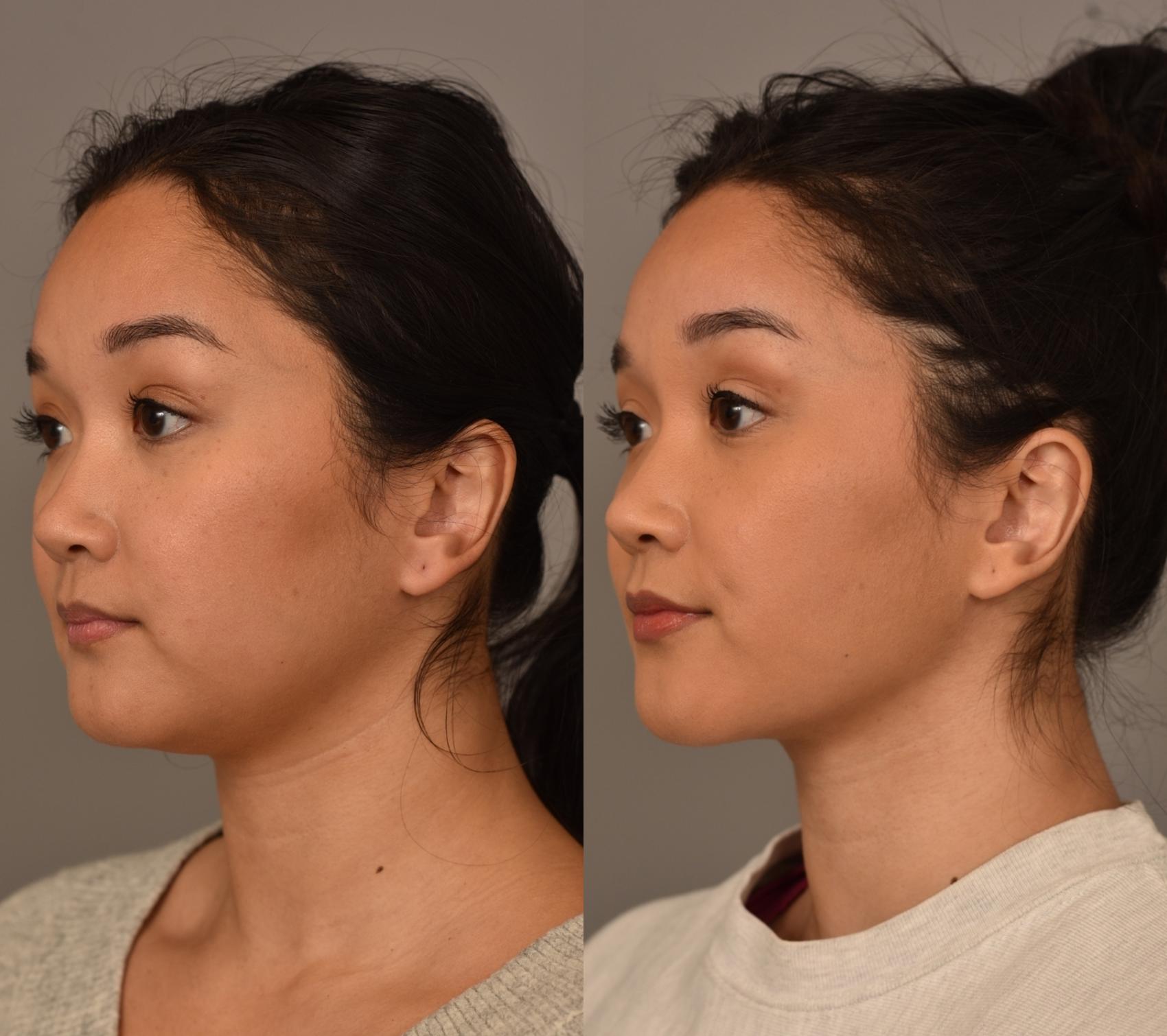 Face Contouring Surgery