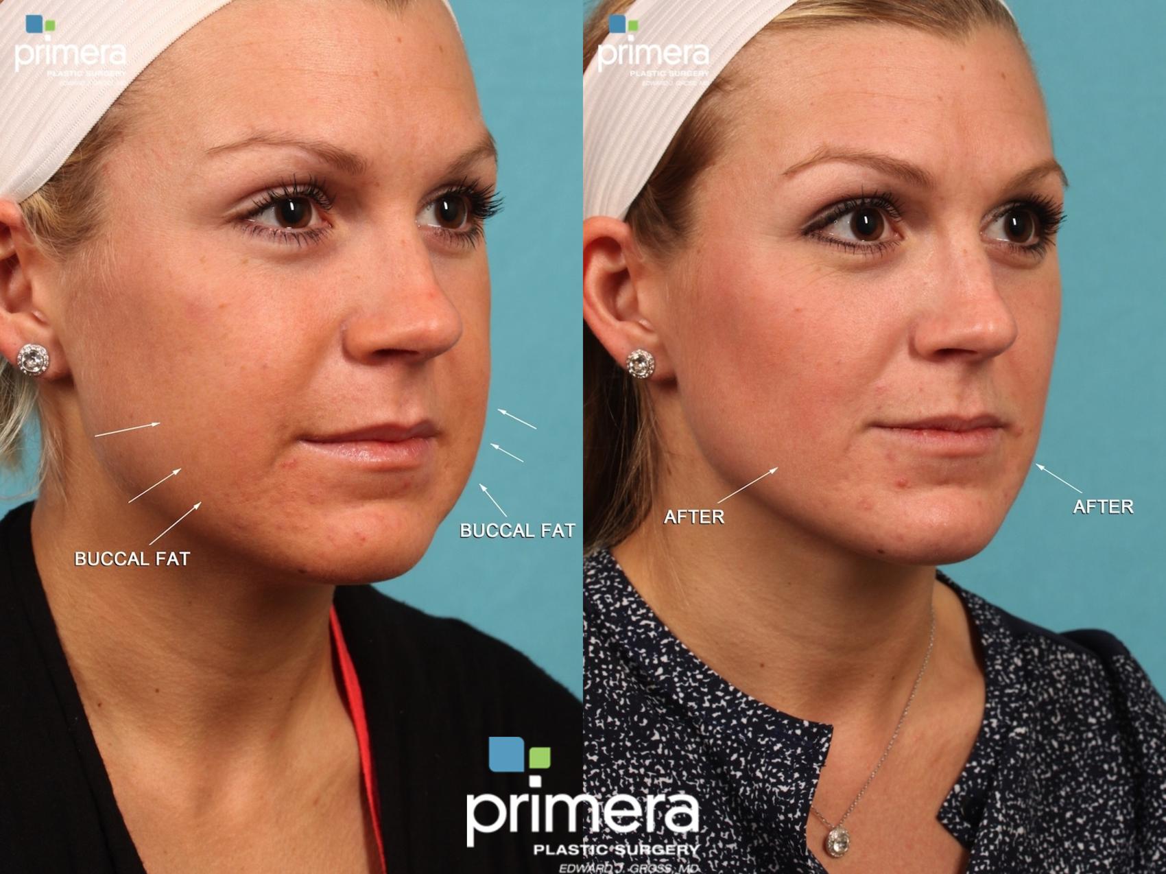 Face Fat Removal Without Surgery