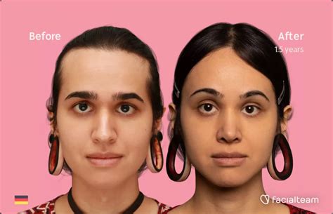 Face Feminization Surgery Before And After