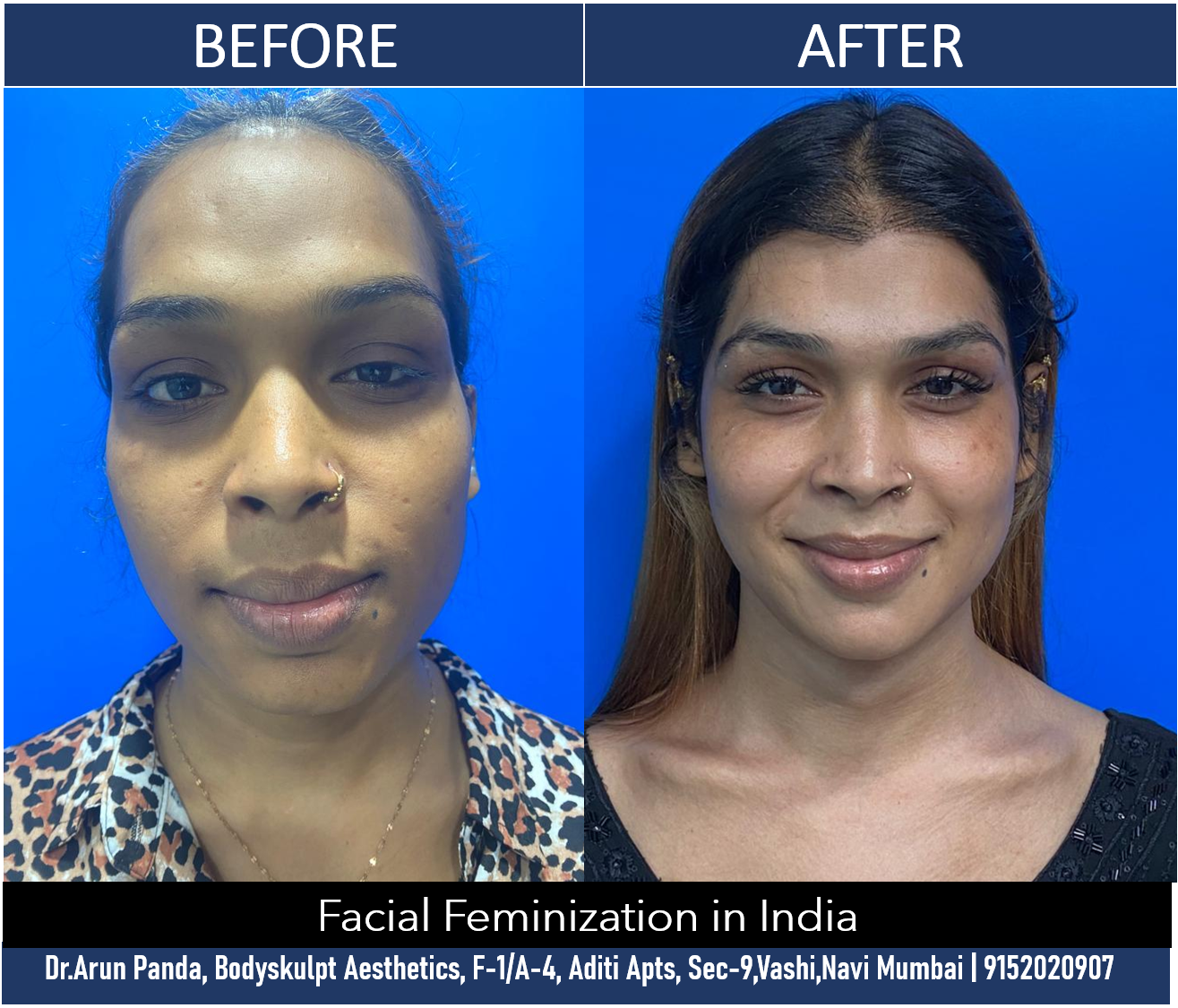 Face Feminization Surgery Cost