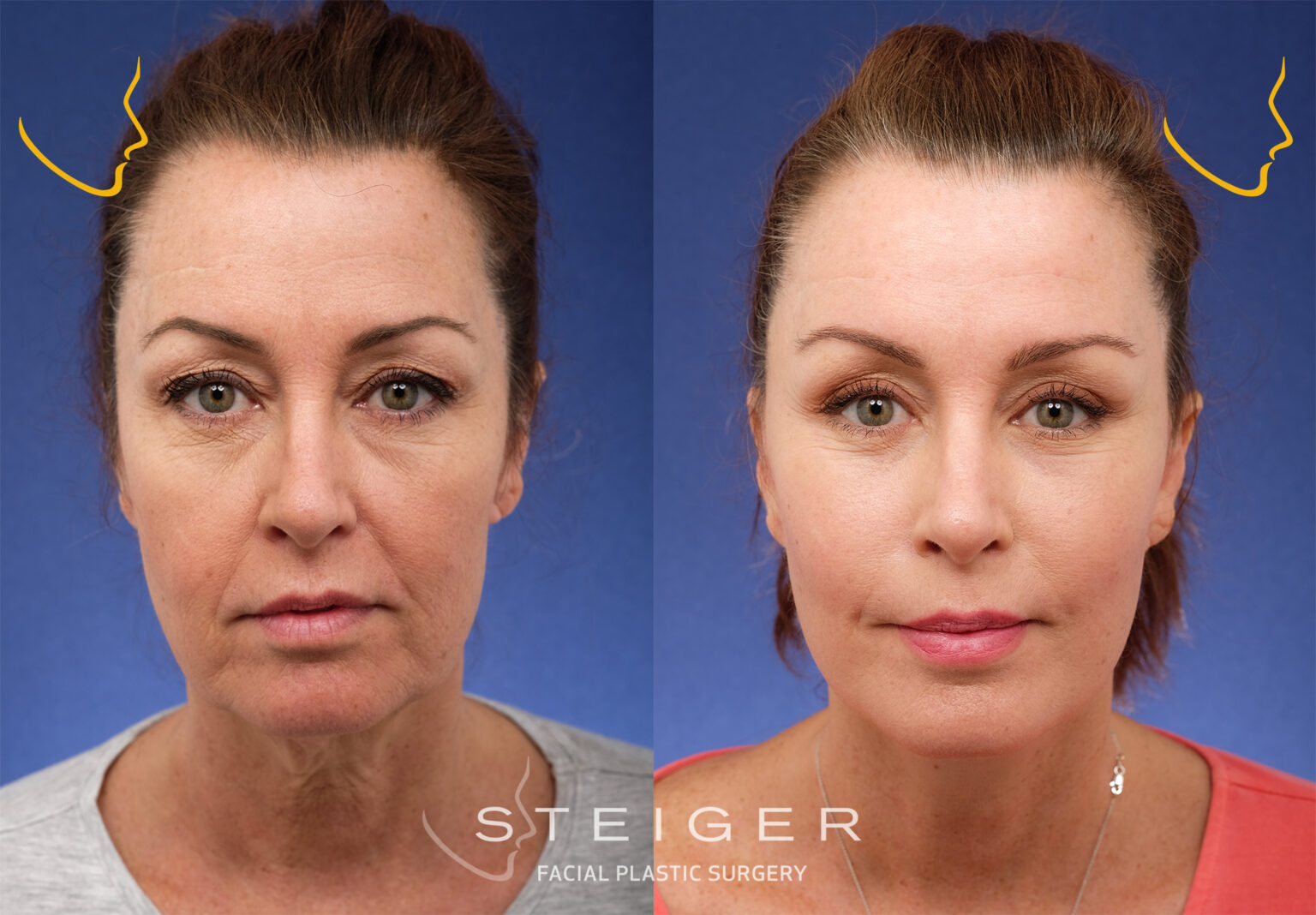 Face Lift Surgery Before After Photos