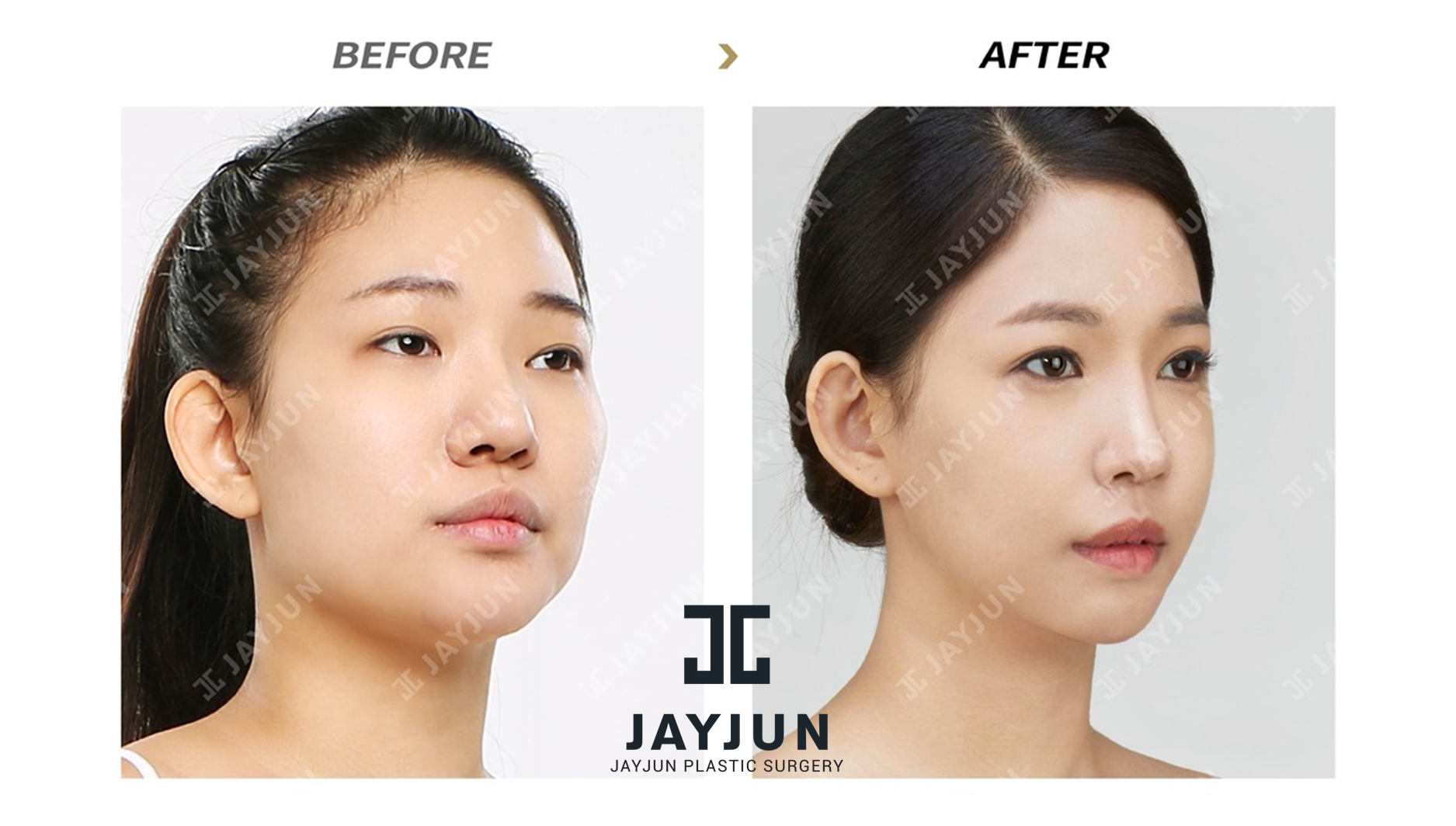 Face Lift Surgery In Korea