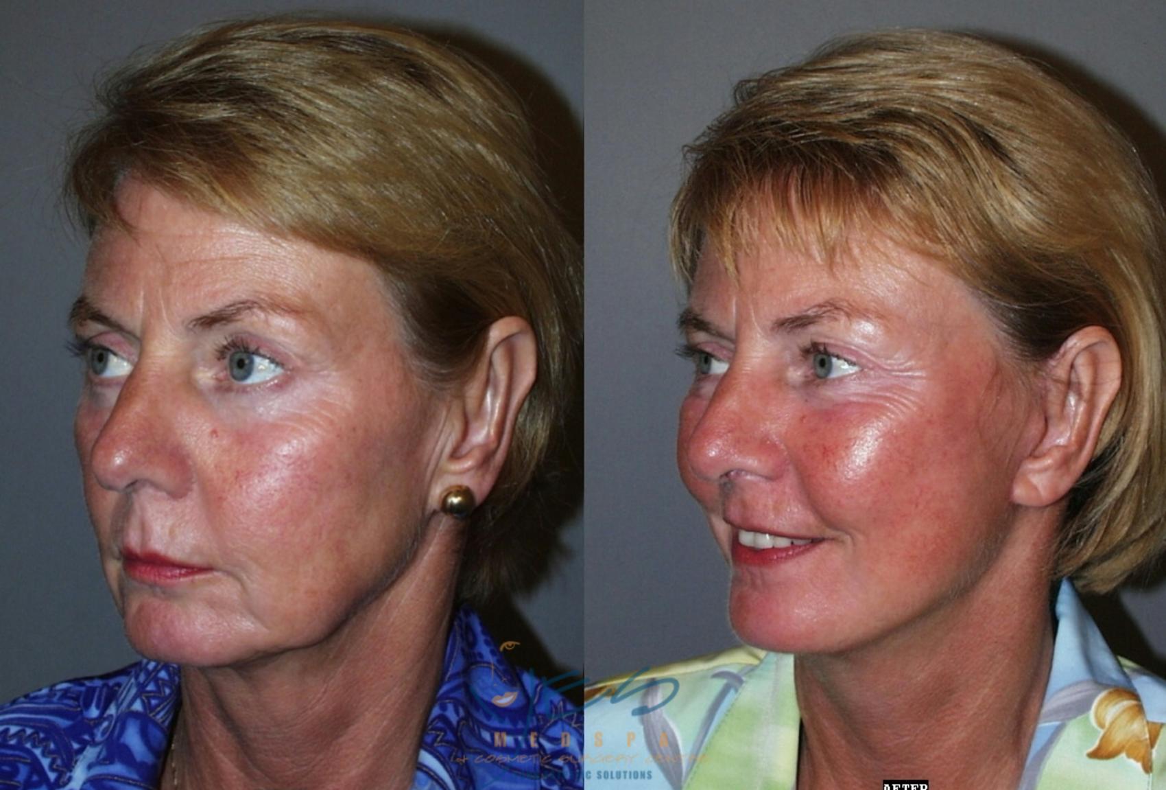 Face Lift Surgery Photos